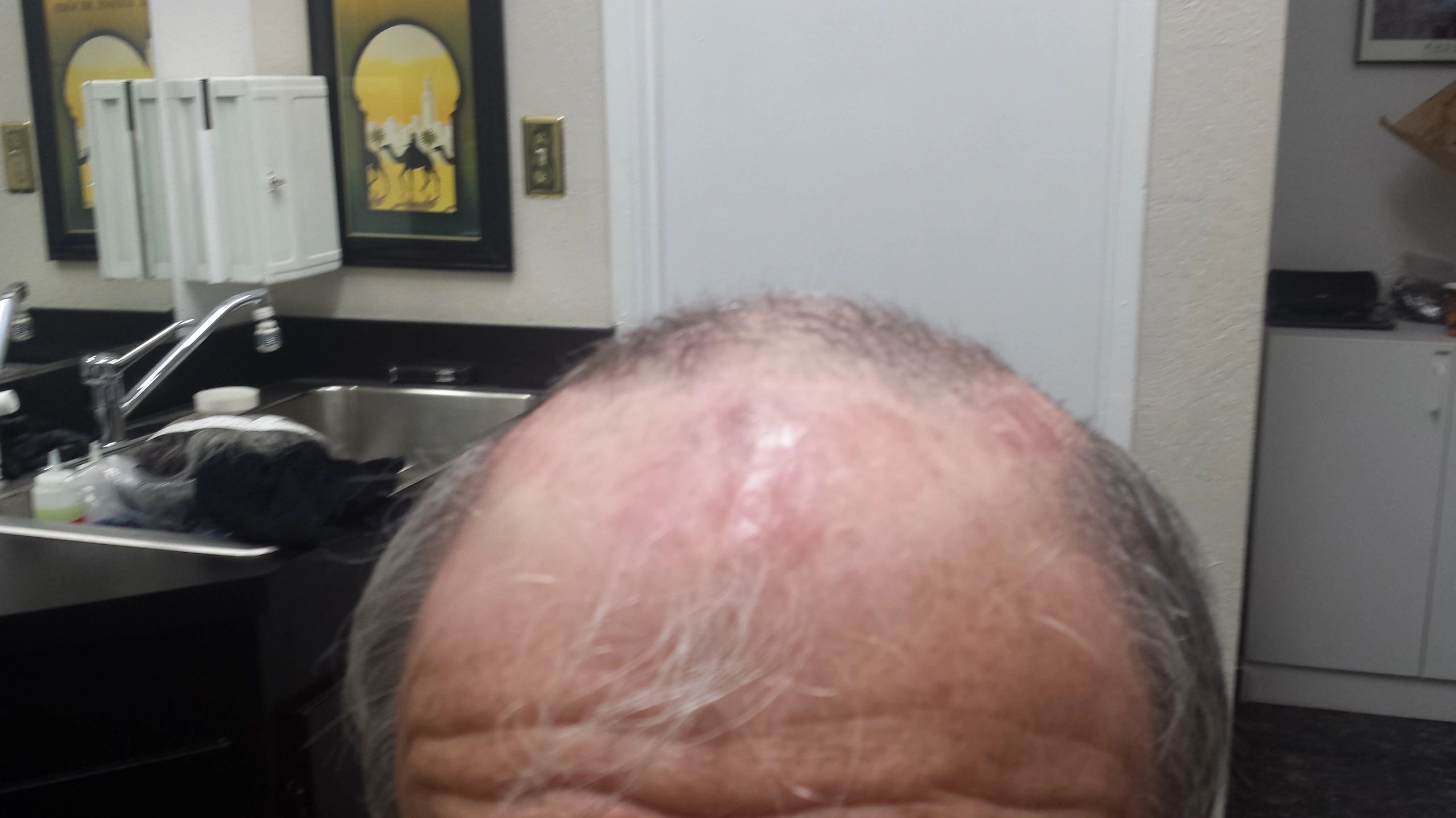 Close-up of thinning hair